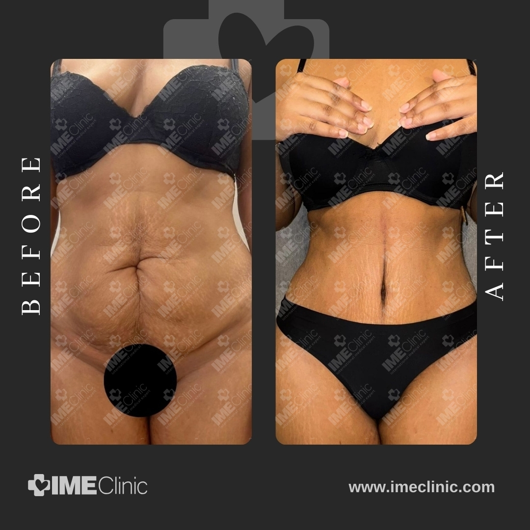
                                     Side-by-side before and after images of a person’s midsection. The before shows loose and sagging skin, while the after reveals a toned and tightened appearance. The person is wearing black undergarments in both pictures.